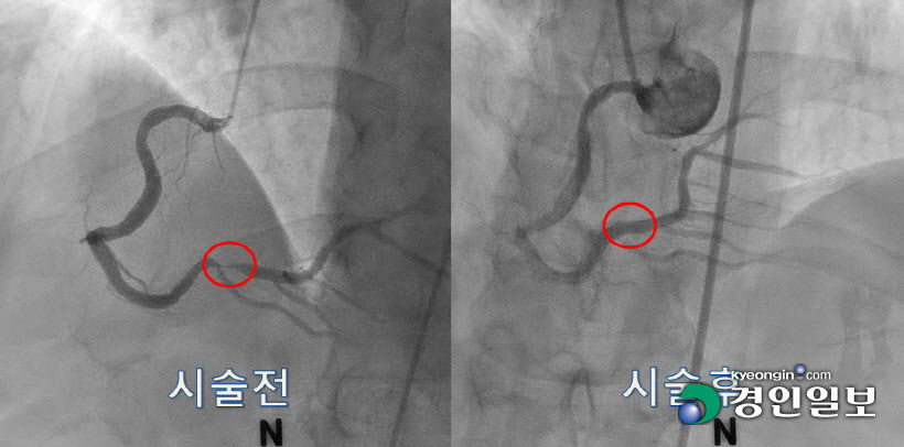 경기도의료원 이천병원, 스텐트 시술로 협심증 환자 치료 성공